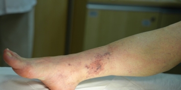 Varis Tedavisinde Yeni Yöntemler ve Başarılar