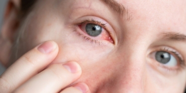 Kuru Göz Hastalığı: Belirtiler ve Tedavi Yöntemleri