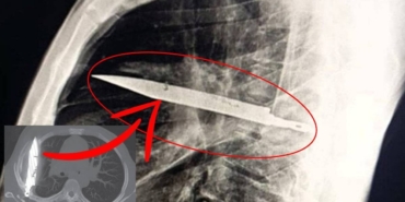 On Yıl Sonra Bıçakla Yaşamak: Şok Edici Röntgen!