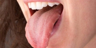 Dildeki Beyaz Lekeler: Ciddi Hastalık Belirtisi!