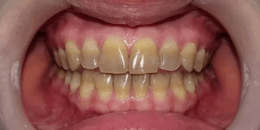 Diş Renkleri Sağlığınızı Ele Veriyor!