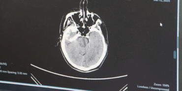 Gençlerde Beyin Kanaması Artıyor: Dikkat!