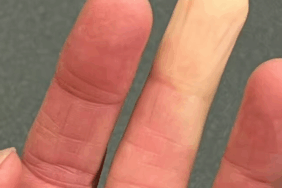Raynaud Hastalığı: Üşümekle Sınırlı Değil! Raynaud Hastalığı: Üşümekle Sınırlı Değil!