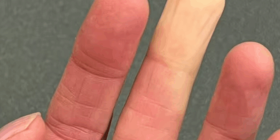 Raynaud Hastalığı: Üşümekle Sınırlı Değil! Raynaud Hastalığı: Üşümekle Sınırlı Değil!