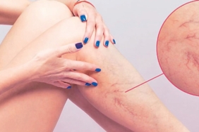 Varis: Estetik Sorun Değil, Ciddi Bir Hastalık!