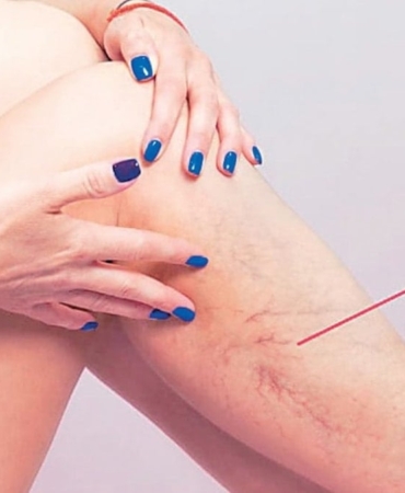 Varis: Estetik Sorun Değil, Ciddi Bir Hastalık!