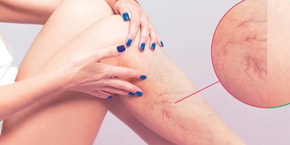 Varis: Estetik Sorun Değil, Ciddi Bir Hastalık!