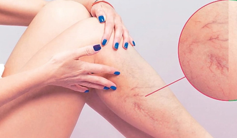 Varis: Estetik Sorun Değil, Ciddi Bir Hastalık!