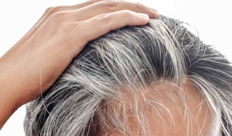 Beyaz Saçlar: Vücudun Koruma Mekanizması mı?