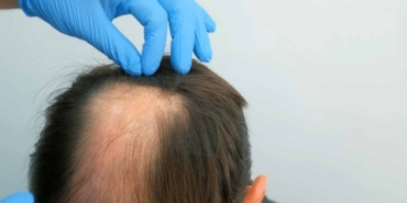 Stresin Saç Dökme Mekanizması Bilimle Açığa Çıktı