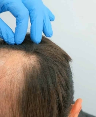 Stresin Saç Dökme Mekanizması Bilimle Açığa Çıktı