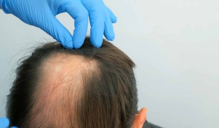 Stresin Saç Dökme Mekanizması Bilimle Açığa Çıktı