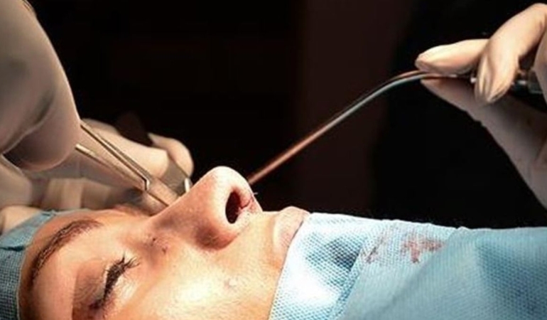 Rinoplasti: Estetik ve Fonksiyonel Cerrahinin Önemi