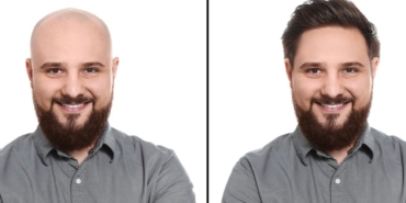 Saç Dökülmesine Çözüm: Yeni Serum Devrim Yaratıyor!