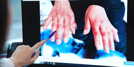 Soğuk Isırığına Dikkat! Ciddi Sağlık Riskleri